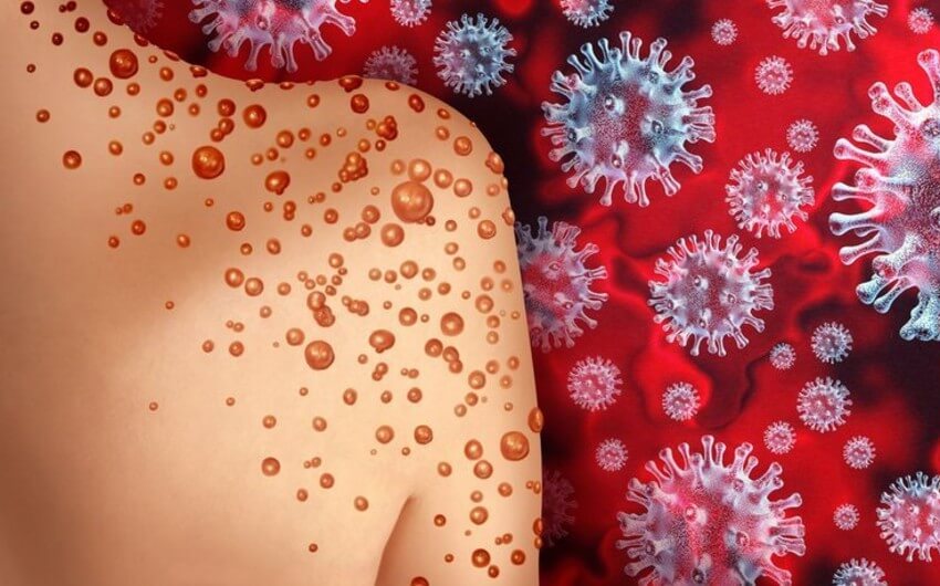 Azərbaycanda meymunçiçəyi virusuna yoluxma faktı aşkarlanıb - RƏSMİ