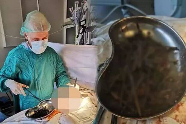 Əməliyyat zamanı gənc qızın mədəsindən 158 metal əşya çıxdı – VİDEO