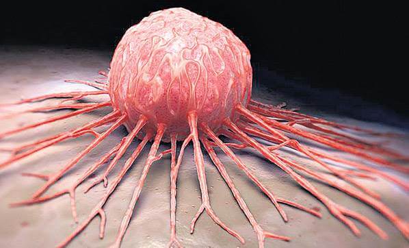 Xərçəng xəstəliyinin ən çox yayıldığı ölkələr - TOP-10