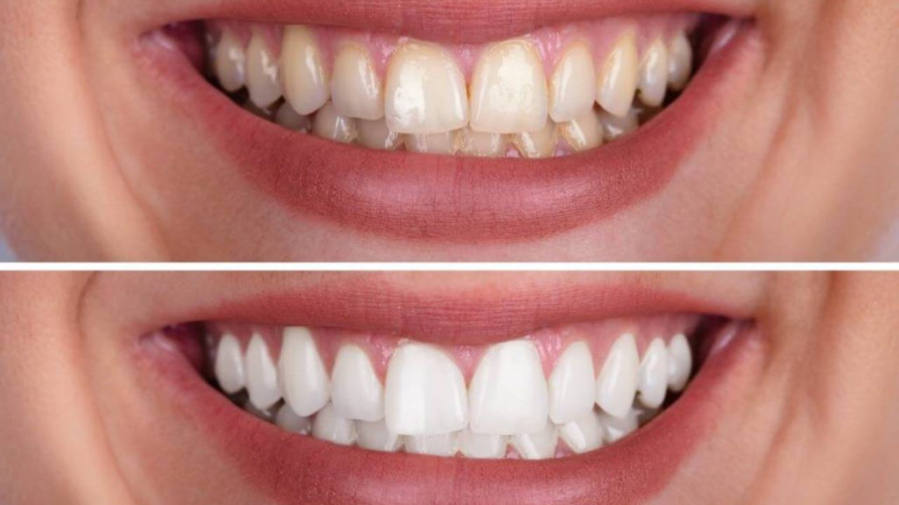 Saralmış dişləri ağartmaq üçün diş ağardıcılardan istifadə etmək nə dərəcədə düzgündür?