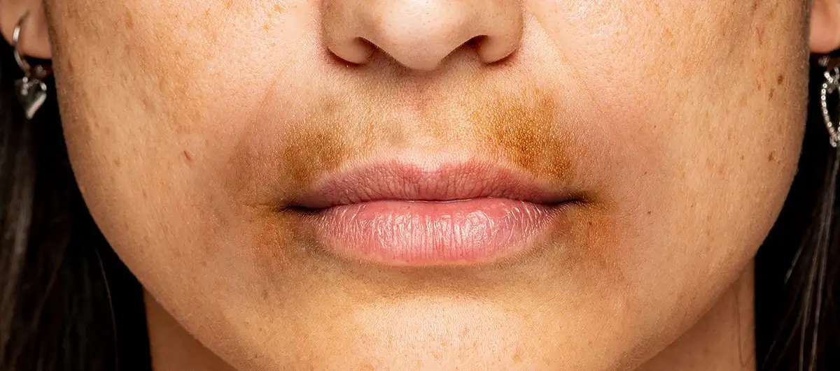 Dodaqlar ətrafında qaralma niyə baş verir?