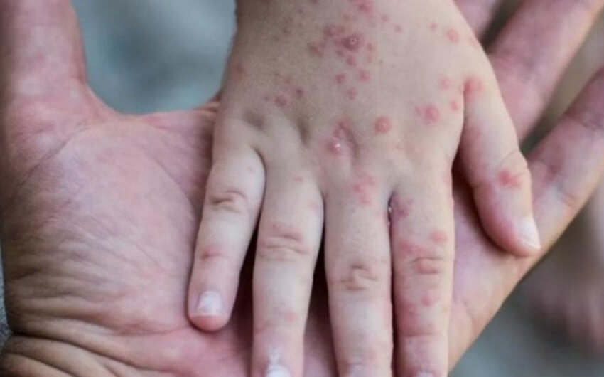 Monqolustanda qızılcaya yoluxan vətəndaşların sayı 7 mini ötüb